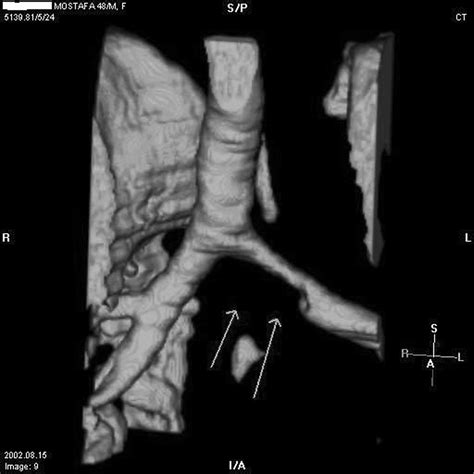 Three Dimensional Reconstruction Of Thoracic Ct Scan Showing Severe Download Scientific Diagram