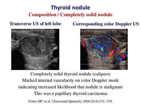 Ultrasound of thyroid nodules