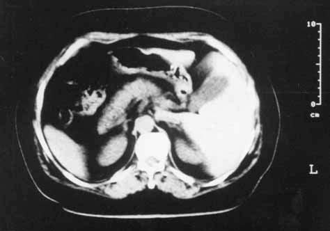 Abdominal C T Showing The Liver And The Gallbladder On The Left Side