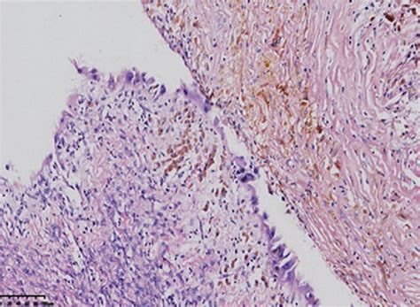 He Staining Of Atypical Hyperplasia Human Ovarian Endometrium A