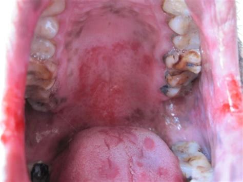 Erythema Multiforme Oral