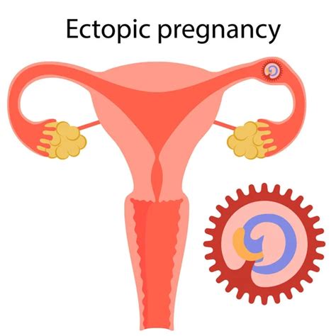 Ectopic Pregnancy Vector Images Depositphotos