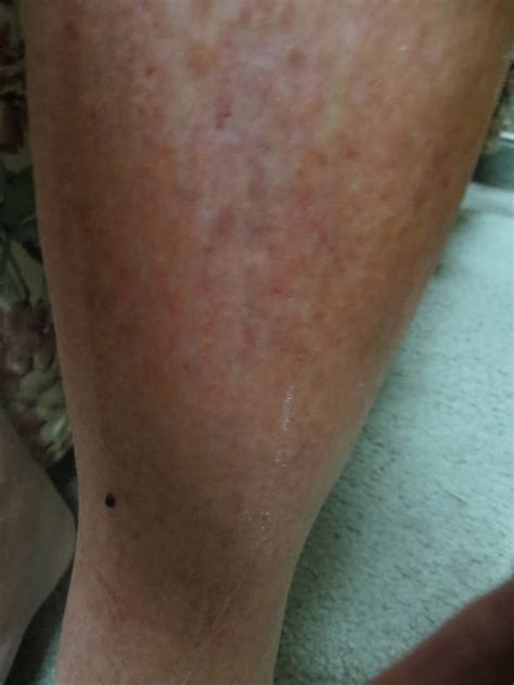 PrunePicker: Extreme itching! Front of lower legs.