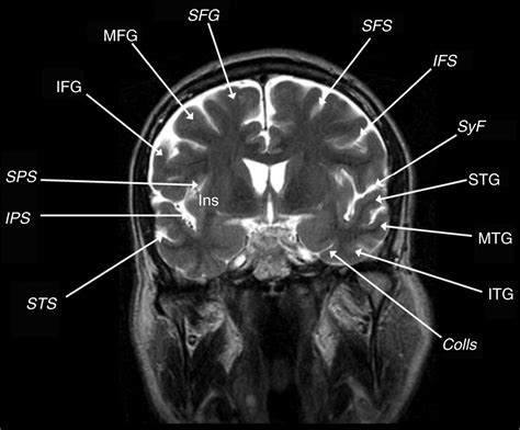 Mri Paracentral Lobule