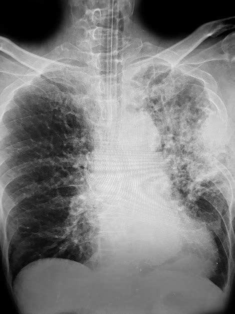 Premium Photo A Chest Xray Shows A Chest Xray With A Large Lung Xray