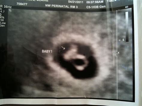 Baby Ultrasound: Baby Ultrasound At 6 Weeks