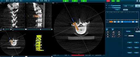 What Is Spine Surgical Navigation System Is Spine Surgical Navigation