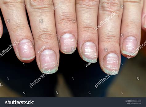 Why Are My Nails Peeling Causes Of Flaking Peeling Nails Atelier