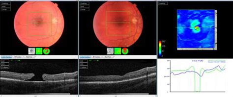 Oct Scan Of One Of The Cases In The C F Group Preoperative And