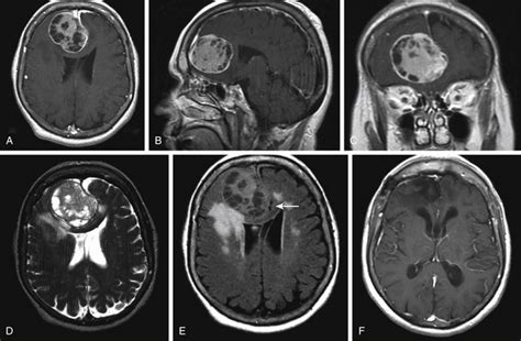 Surgical Approach To Falcine Meningiomas Clinical Gate