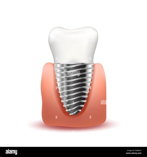 Implante dental realista con tornillo metálico en color rosa chicle en