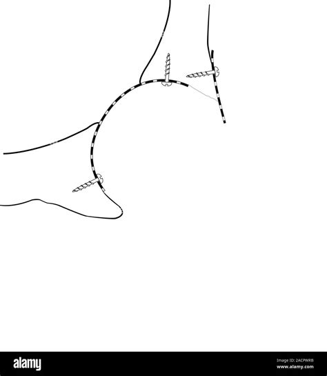 Hip Socket Bone Grafting Diagram Showing The First Stage In Hip Socket