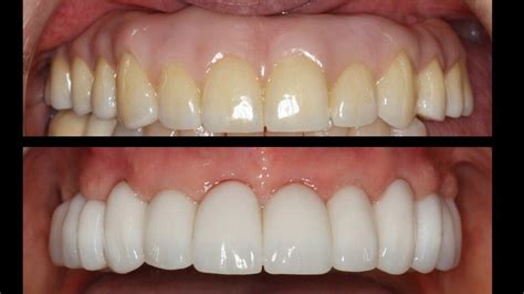 Fixed Bridges vs Fixed Dentures - The Complete Guide