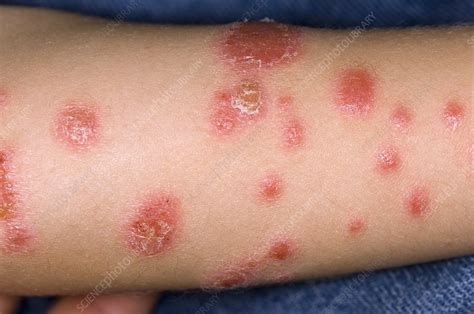 Psoriasis On Arms