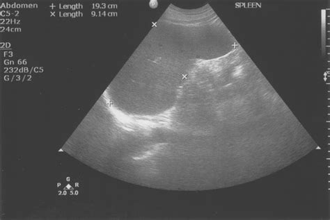 Abnormal Spleen Ultrasound