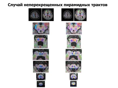 Ствол мозга. Продолговатый мозг - презентация онлайн