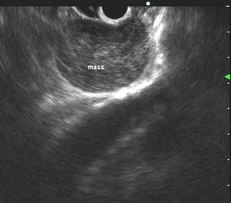 Endoscopic Ultrasound Features A Hypoechoic Mass With A Slight