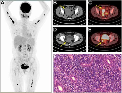 Full Article Uterine Burkitt Lymphoma With Rare Extranodal Deposits In