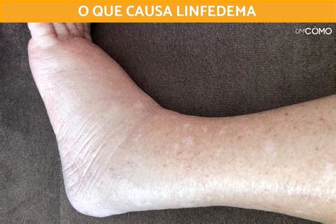 O Que Causa Linfedema - O que causa linfedema - Descubra tudo sobre a inflamação dos tecidos