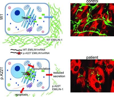 Diagnostic Exome Sequencing Identifies A Novel Gene Emilin