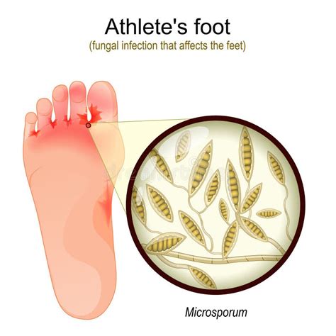 Athlete`s Foot. Fungal Infection that Affects the Feet Stock Vector ...