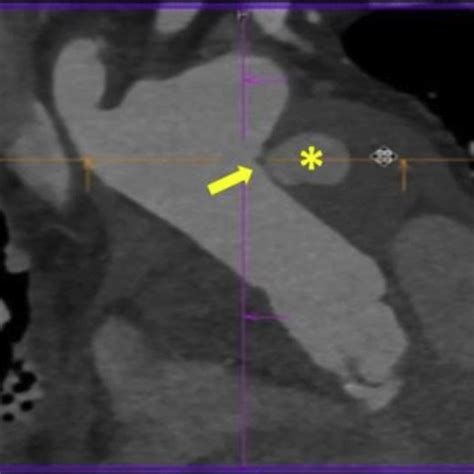 Ascending Aortic Aneurysm Repair A On Admission Preoperative Cardiac