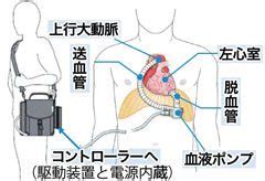 琉大が県内初体内植え込み型補助人工心臓手術 琉球新報デジタル