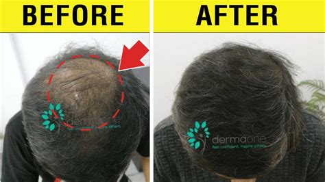 Top 48 image derma roller for hair growth - Thptnganamst.edu.vn