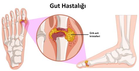 Gut Hastalığı Nedir Belirtileri ve Tedavisi Nelerdir