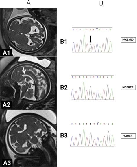 Unusual Association Of SCN2A Epileptic Encephalopathy With Severe