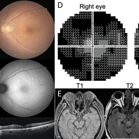 A Color Fundus Photography Shows Subtle Discoloration At The Posterior