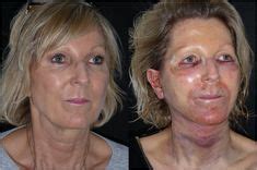 Facelift Recovery Ideas Facelift Recovery Facelift Plastic Surgery