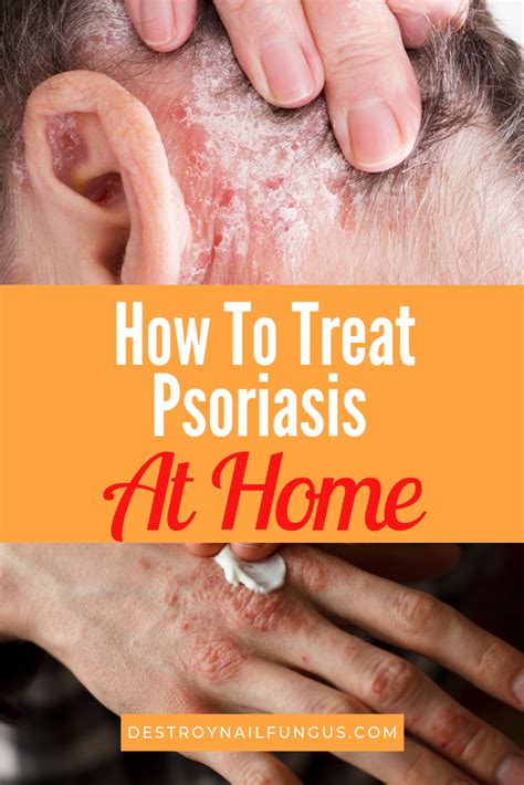 Psoriasis Cure Evanne Constancy