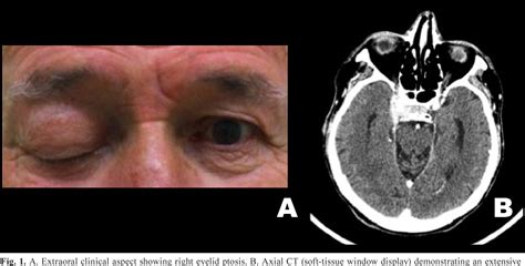 Table 1 From Orbital Apex Syndrome Affecting Head And Neck Cancer