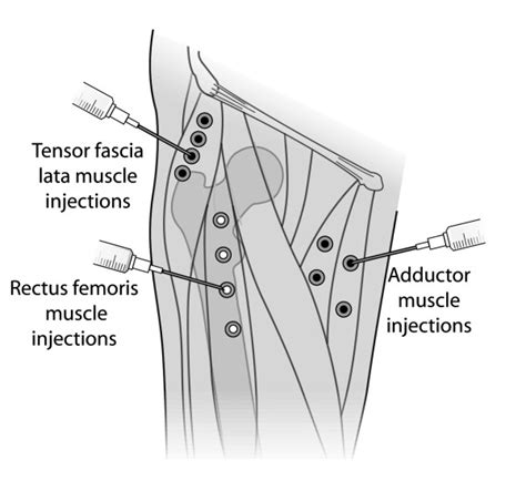 Botulinum Toxin Injection Points Illustration Of The Locations Of The Download Scientific