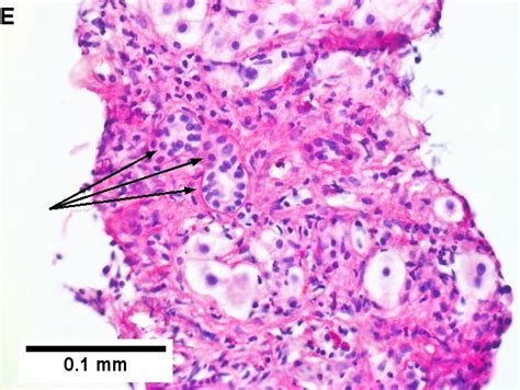 Primary Biliary Cirrhosis Libre Pathology