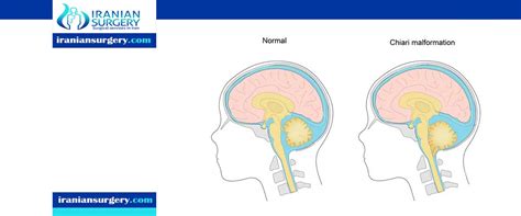 Chiari Malformation Treatment - Iranian Surgery