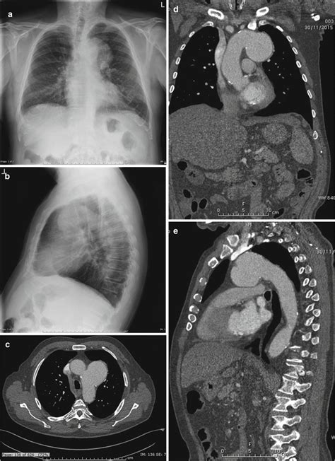 Aortic Aneurysms Fistula And Thrombus Radiology Key