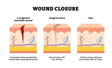 Before after wound closure steps from surgical or traumatic wound to ...