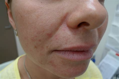 Acd A Z Of Skin Perioral Dermatitis