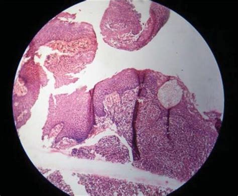 Histopathological section showing spongiosis | Download Scientific Diagram