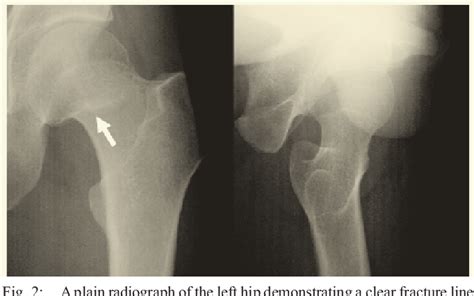 Figure 2 From Simultaneous Bilateral Femoral Neck Stress Fractures In A