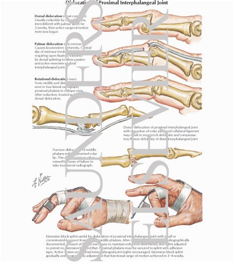 Dislocation of Proximal Interphalangeal Joint