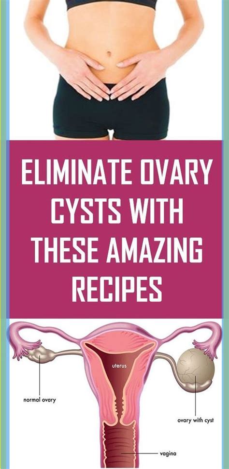 Wellness In 2020 Cyst On Ovary Health And Fitness Articles Holistic