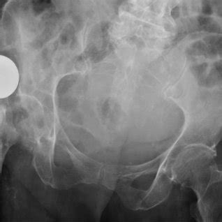 1 Anteroposterior Radiograph Of The Pelvis And 2 Lateral Radiograph