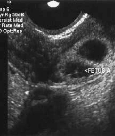 Figure 1 From Transvaginal Sonographic Diagnosis Of Unilateral Tubal Ectopic Pregnancy In