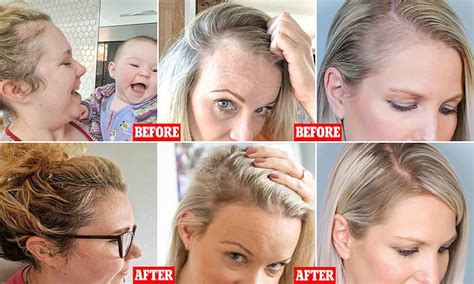 New Mothers Who Suffered Postpartum Hair Loss Reveal How Pea Shoot Supplements Regrew Their