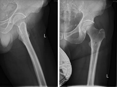 Tuberculous Osteomyelitis Of The Proximal Femur Masquerading As Bone Secondary A Case Report