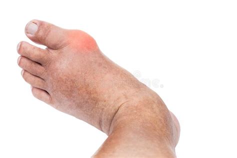 Man With Swollen Deformed Inflammed Toe Joint With Painful Gout On