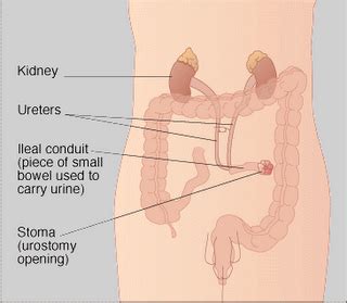 health journal: ileal conduit